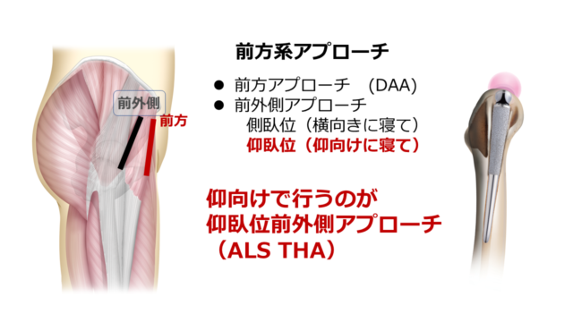 ・前方系アプローチ（DAA）、・前外側アプローチ/側臥位（横向きに寝て）/仰臥位（仰向けに寝て）、仰向けで行うのが仰臥位前外側アプローチ（ALS THA）