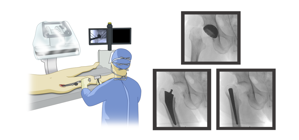 医師が股関節を前方系アプローチで切開しているイラスト画像