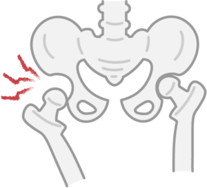 股関節が脱臼している画像